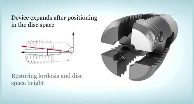 Image of Wenzel Spine Varilift&reg; Interbody Fusion System, highlighted in marketing video.